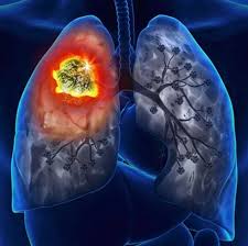 Akciğer Kanseri - Tıbbi Görsel